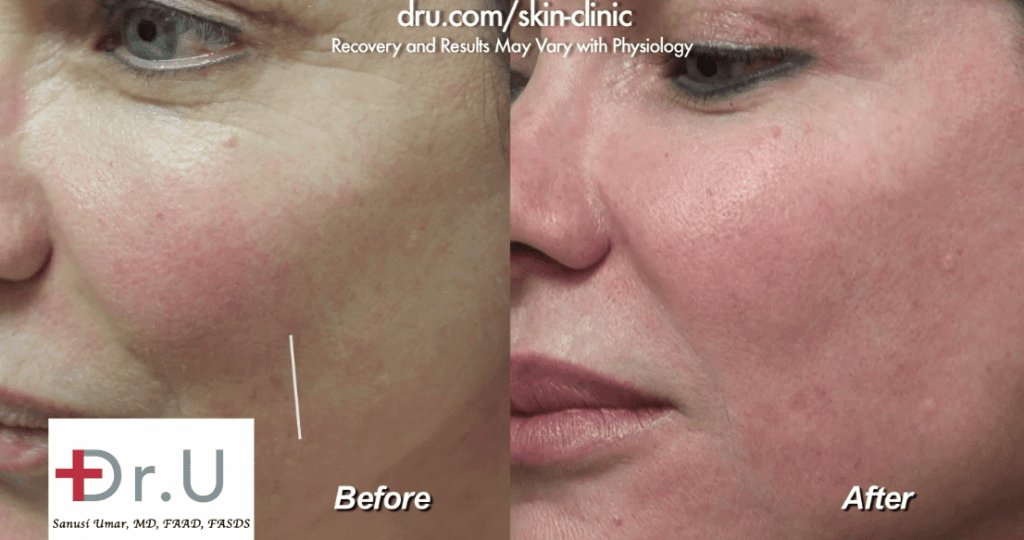 Before and after photo of Belotero vs Juvederm treatment for fine line.