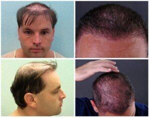 Some individuals will resort to more extreme uses of wigs and hairpieces. Rather than using glue or double-sided tape, this Los Angeles patient had his hairpiece stitched to his scalp, a mistake that became very difficult to reverse. He defied his odds through a Dr.UGraft ™ body hair transplant and achieved a standard, natural-looking coverage.*