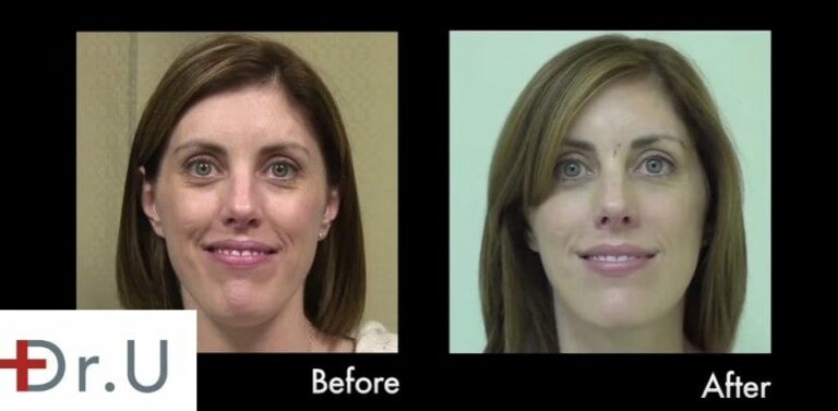 Hyaluronic acid fillers may be the best dermal filler injection for the early onset of laugh lines (nasolabial folds) Hyaluronic acid fillers may be the best dermal filler injection for the early onset of laugh lines (nasolabial folds)