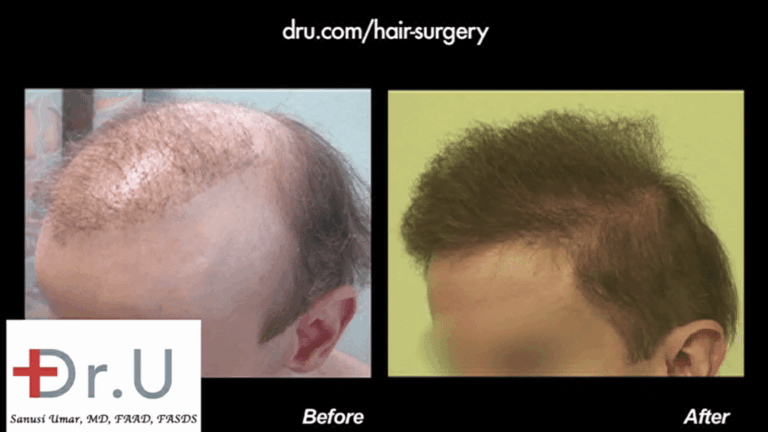 Is non-surgical hair replacement worth it? Most people would probably say no. But victims of harmful hair restoration procedures may have no choice but to use some toupee to hide scarring and unsightly results, like this patient. With the help of a Dr.UGraft body hair-to-head procedure, he could discard his hairpiece and finally enjoy a sense of peace through a full head of naturally growing hair.*
