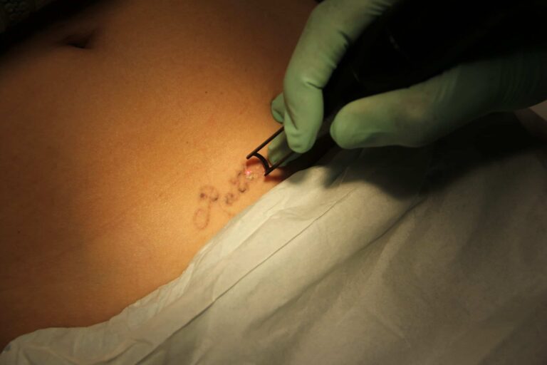 Dr. U skillfully breaks up the pigment in the Manhattan Beach patient's tattoo with the Lutronic Spectra Q- Switched ND:YAG laser for the best results after laser tattoo removal Dr. U skillfully breaks up the pigment in the Manhattan Beach patient's tattoo with the Lutronic Spectra Q- Switched ND:YAG laser for the best results after laser tattoo removal