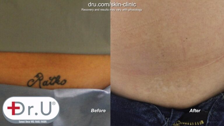 The Manhattan Beach patient was pleased with the results of her laser tattoo removal before and after her final session. The Manhattan Beach patient was pleased with the results of her laser tattoo removal before and after her final session.