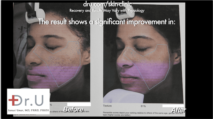 Using the Fraxel Dual can offer the best laser treatment for acne scars, particularly for ethnic patients. This is due to the ability of the laser to target areas without overheating the surrounding skin.*