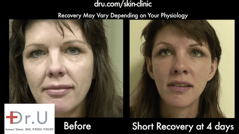 Patient's nasolabial folds show major improvement 4 days after her Silhouette Lift