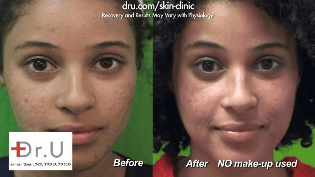 The patient is very happy with her results from Dr. U Skin Clinic after her Fraxel Dual laser treatment for acne scars.
