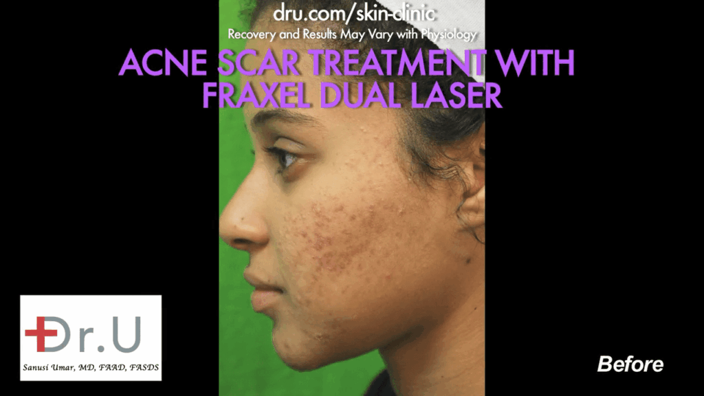 Santa Monica patient struggled with acne in college and was resigned with it. She had tried over-the-counter medication, which did not work, so she followed up with Dr. U for laser treatment for acne scars.*