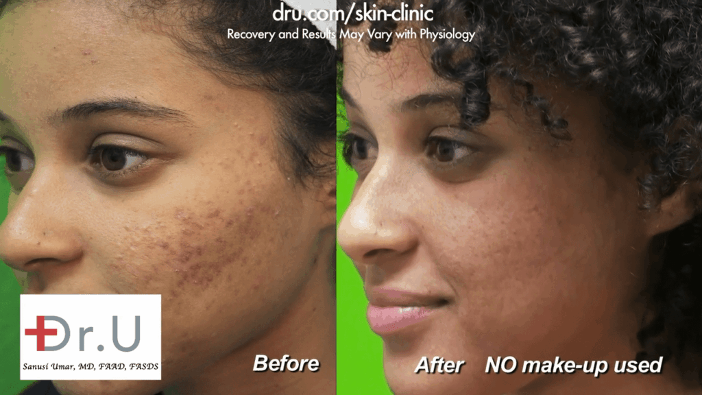 The patient from Los Angeles is able to feel comfortable in her own skin without the use of makeup to cover her acne scars. For many people who struggle with acne scarring, this feeling far outweighs laser treatment for acne scars cost.*