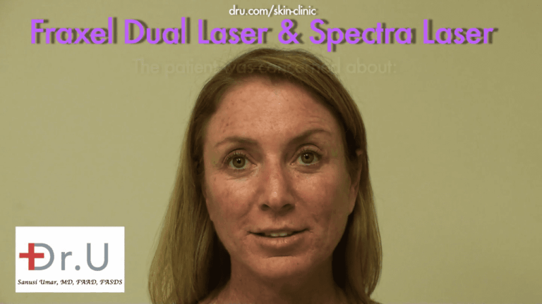 This patient from El Segundo, Los Angeles consulted Dr. U about age spots on face and neck areas. The appearance of the brown dots concerned her. 