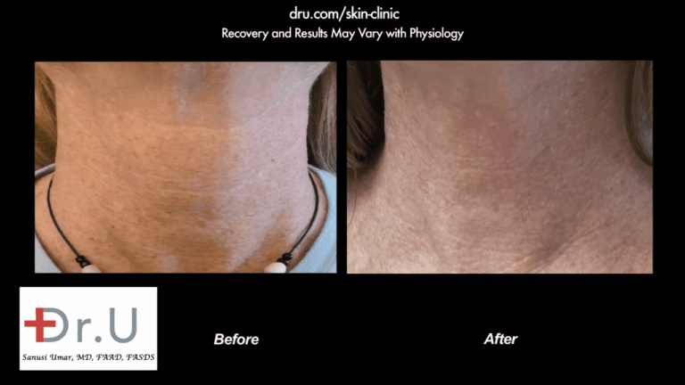 The patient was happy to get rid of not just the age spots on face, but those on her neck as well.