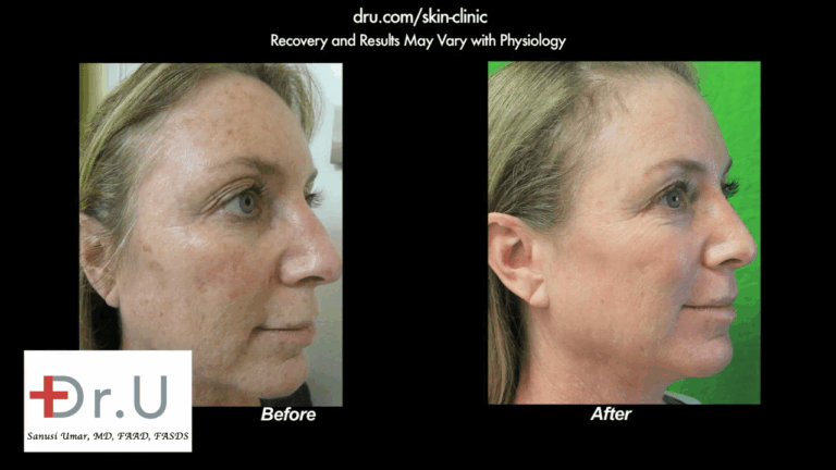 Profile view showing the other side of the patient's face after undergoing the best age spot remover treatment with Dr. U in Los Angeles.*