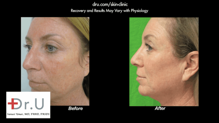 A profile view of the El Segundo, Los Angeles patient showing the results of removing age spots on face with laser therapy.