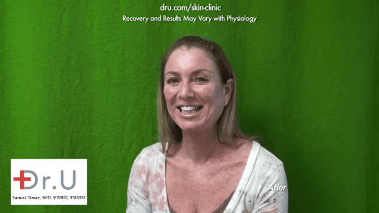 The patient was very happy and would recommend treatment with Dr. U to anyone wondering how to remove age spots on face.