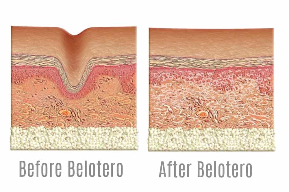 How Belotero works for forehead creases and other wrinkles. Image - Belotero.com