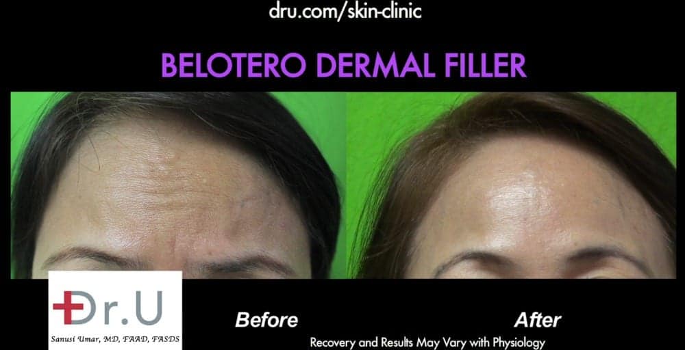 Forehead furrows are no longer apparent on the patient.*