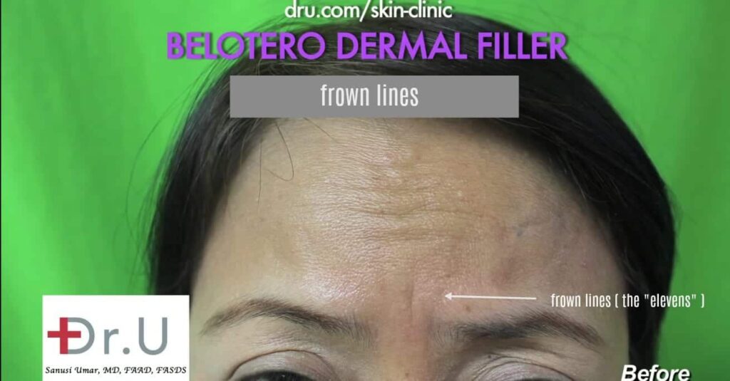 Manhattan Beach, Los Angeles patient wants to get rid of frown lines with Belotero.