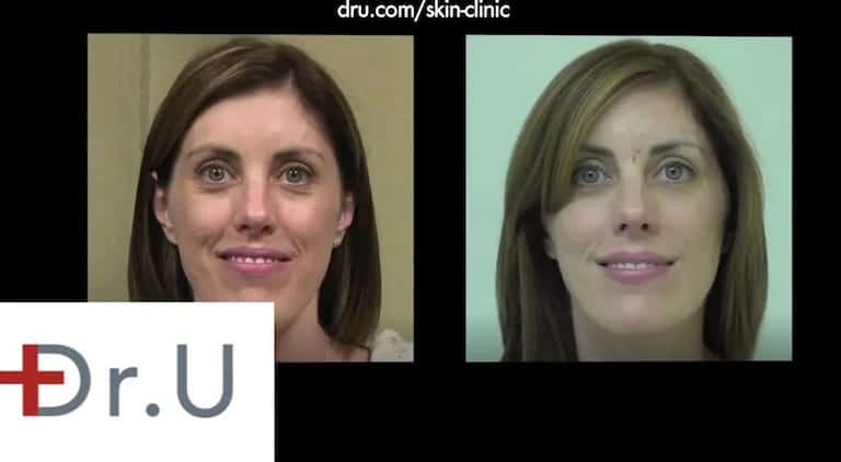 How to Get Rid of Laugh Lines With Hyaluronic Acid Fillers