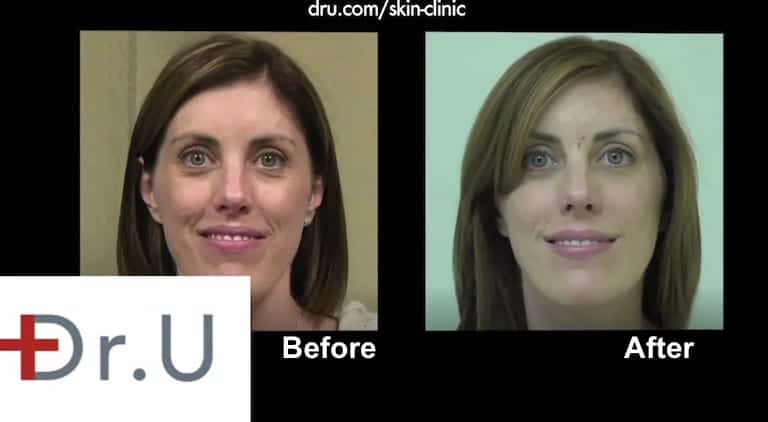 Patients in Los Angeles Have Many Types of Dermal Fillers As Options for Treatment