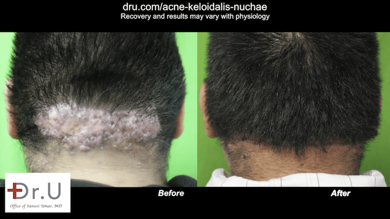 Los Angeles patient is happy to be rid of his AKN, initially mistaken for bumps on scalp after haircut.