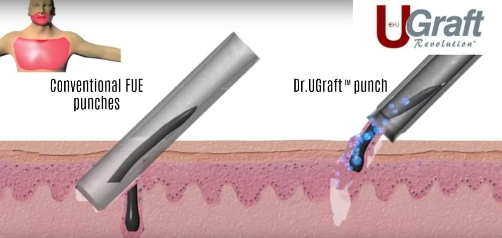 A Dr.UGraft ™ hair transplant with a natural hairline is able to use grafts from the leg, nape or other area of the body using specialized technology.