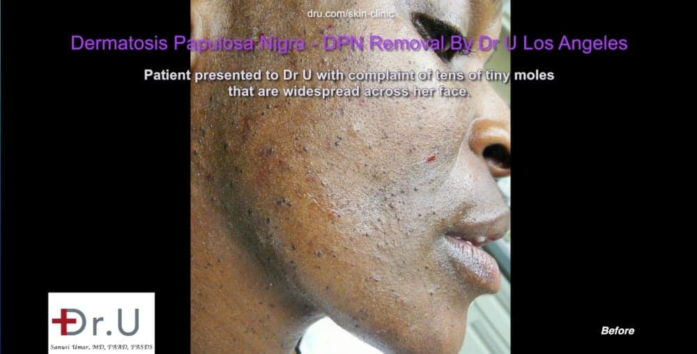 Photos of Westchester, Los Angeles patient show numerous black skin tags on the face and neck.*