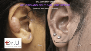 The Manhattan Beach patient wanted to know how to get rid of keloids from ear piercings, and if she would be able to wear earrings again after the removal procedure. Dr. U addressed her concerns in an initial consultation and the "after" photo above shows that she can indeed wear earrings again.