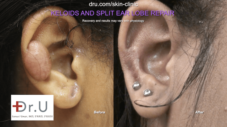The Manhattan Beach patient wanted to know how to get rid of keloids from ear piercings, and if she would be able to wear earrings again after the removal procedure. Dr. U addressed her concerns in an initial consultation and the "after" photo above shows that she can indeed wear earrings again.