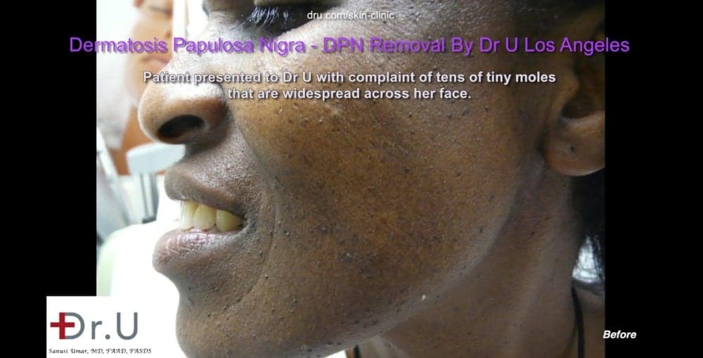 The appearance of black skin tags on the face and neck is due to Dermatosa Papulosa Nigra which develop over time due to genetic and environmental influences.*