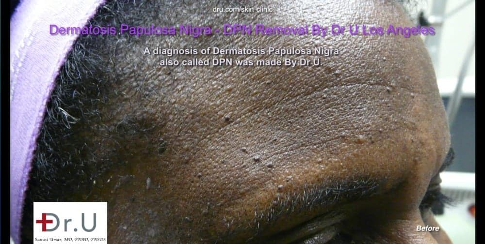 DPN lesions which look like skin tags on the face appear across patient's forehead.