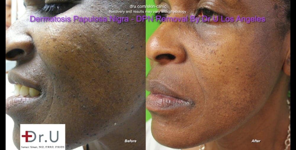Left side comparison photos show a major clearance of black skin tags on the face.*