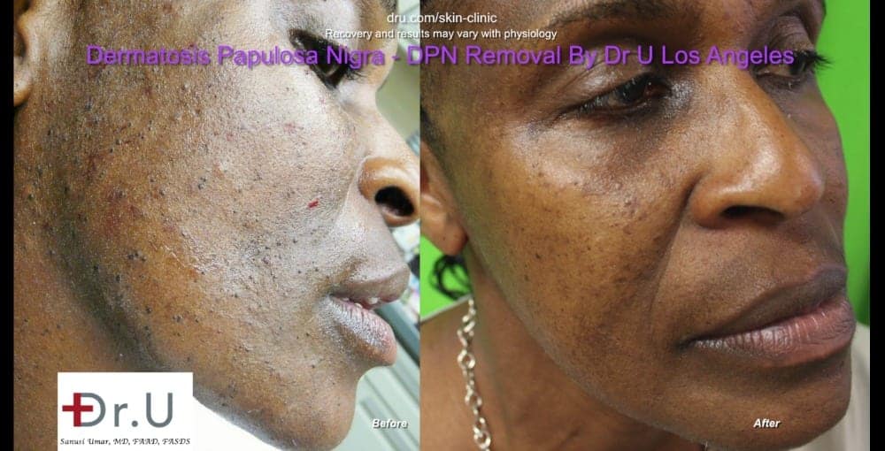 Dermatosa Papulosa Nigra pictures show smoother skin following Dr.U's treatment.*