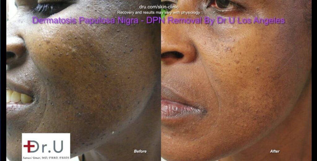 Closeup view showing clearance of dark skin tags on the face.