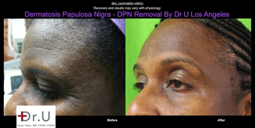 Dermatosa Papulosa Nigra pictures show a smoother looking forehead after Dr.U's electrocautery procedure.