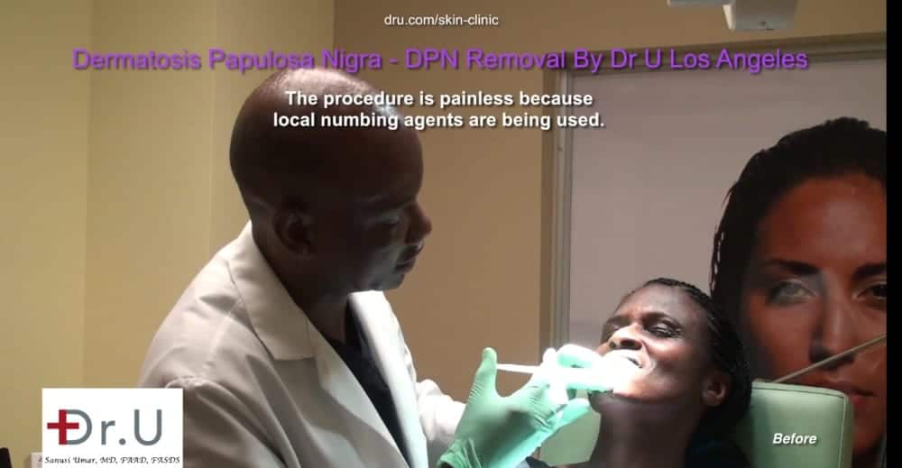 Dr. U uses low current electrocautery to remove black skin tags on the face and neck. The technique can also be used for general skin tags on the face.*