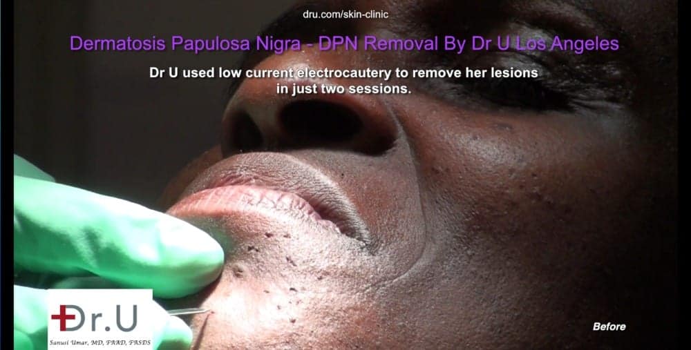 Electrocautery burns and seals blood vessels which feed DPN lesions which look like dark skin tags on the face.*
