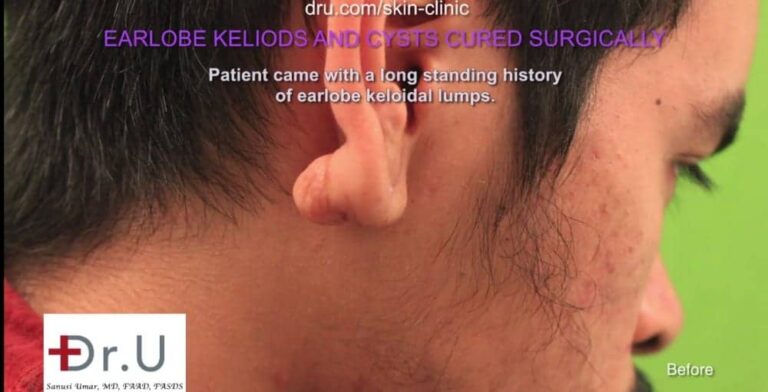 Long Beach, Los Angeles patient with keloid cyst in the ear. Long Beach, Los Angeles patient with keloid cyst in the ear.