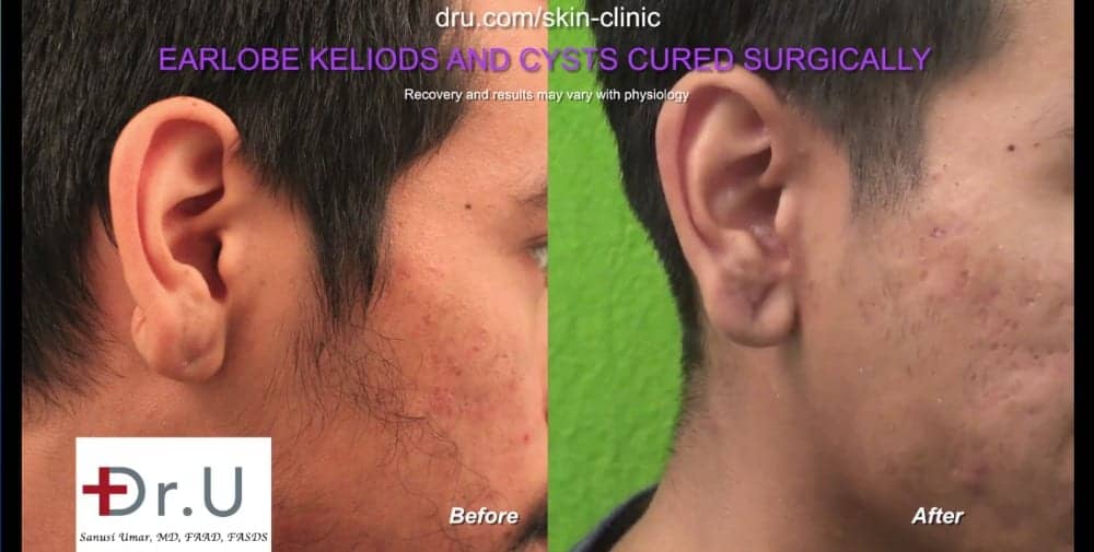 Long Beach, Los Angeles patient before and after his keloid cyst removal procedure performed by Dr. U.