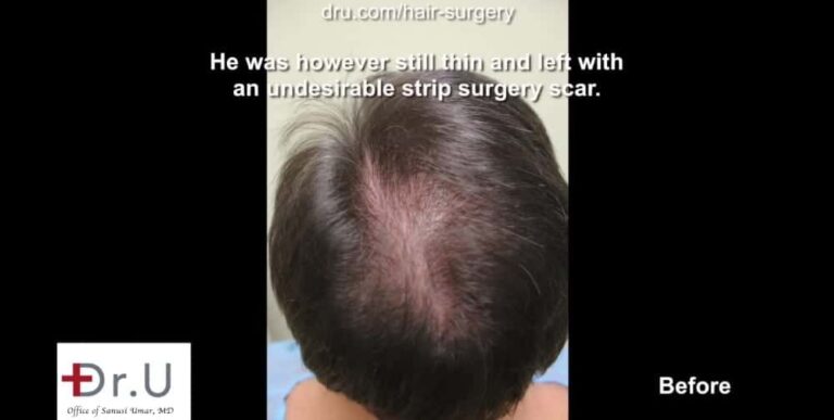 Patient not only hopes for a hair transplant with a natural hairline, but also coverage for the areas of failed growth Patient not only hopes for a hair transplant with a natural hairline, but also coverage for the areas of failed growth.