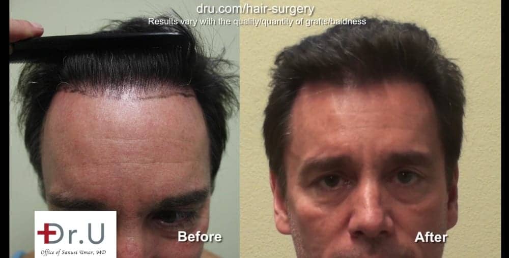 A hair transplant with a natural hairline should have a soft outer edge.