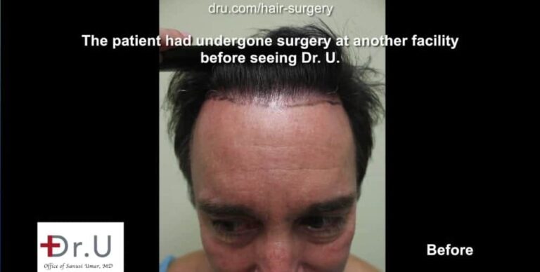 Torrance, Los Angeles patient before his Dr.UGraft™ undetectable hairline transplant. Torrance, Los Angeles patient before his Dr.UGraft™ undetectable hairline transplant.
