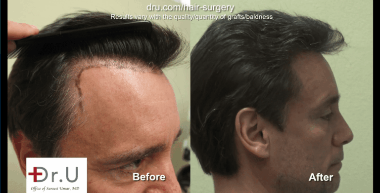 A hair transplant with a natural hairline must focus on the transition of the temples. A hair transplant with a natural hairline must focus on the transition of the temples.