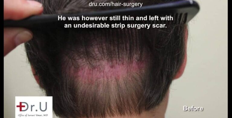 Many people ask, "does a hair transplant look natural" after a strip surgery with a large, obvious scar remaining Many people ask, "does a hair transplant look natural" after a strip surgery with a large, obvious scar remaining