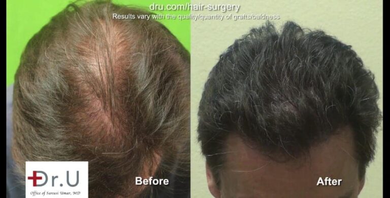 Does a hair transplant look natural? Dr.U's results show that the answer to this question is a resounding yes. Does a hair transplant look natural? Dr.U's results show that the answer to this question is a resounding yes.