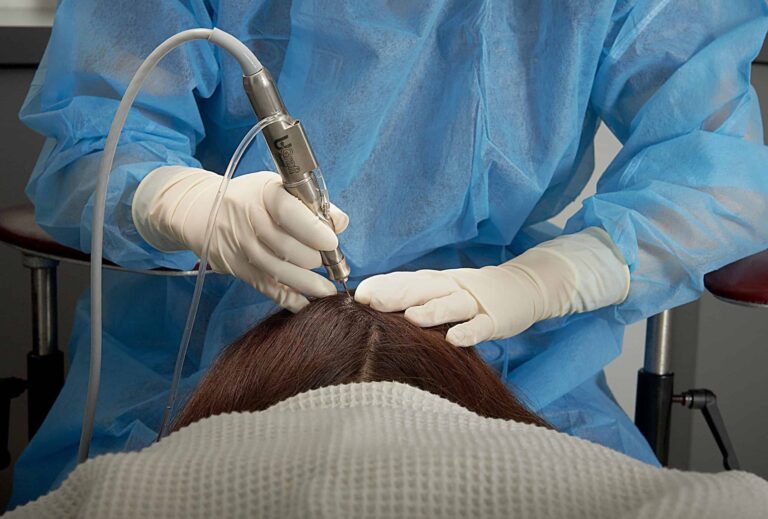 Dr.UGraft™ is the first-ever all-in-one system able to extract hair of all textures from all parts of the body. This includes the nape area, chest area, scalp area, and pubic area. Dr.UGraft™ is the first-ever all-in-one system able to extract hair of all textures from all parts of the body. This includes the nape area, chest area, scalp area, and pubic area.