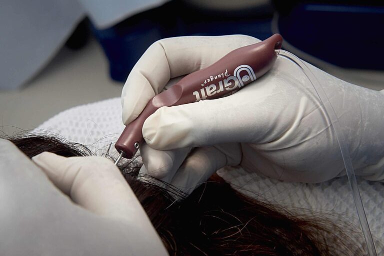the Dr.UGraft™ Curl manual Punch at work on a patient.