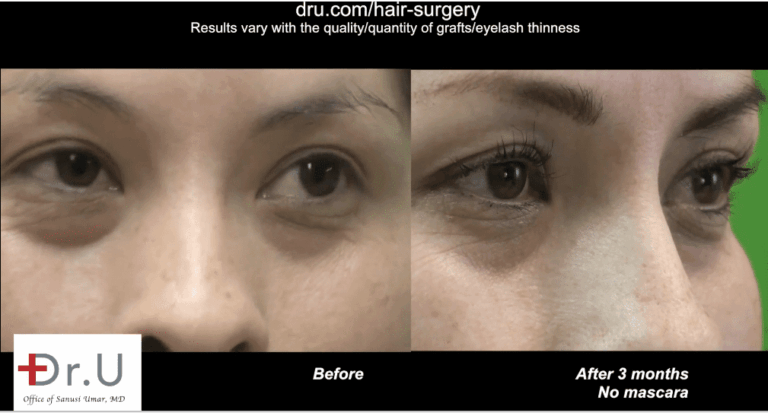 This patient was able to achieve longer, fuller eyelashes with donor grafts from her nape area.*