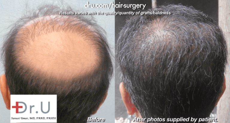 Patient showing low growth yield following a hair transplant before his procedure with Dr.U *