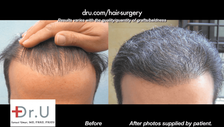 Poor growth yield can be repaired if enough donor grafts are available. If scalp supplies have been exhausted, then body hair may be considered. 