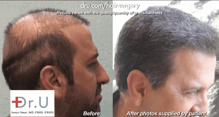 Poor hair transplant growth may result from mistakes in handling and selecting the grafts during surgery *