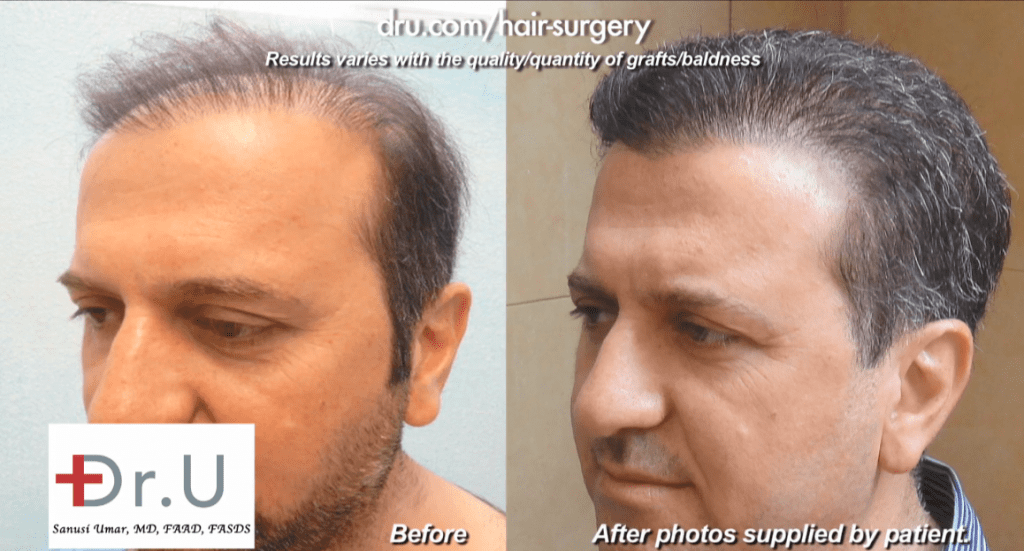 Sometimes there are no obvious causes that explain the phenomenon of no growth after a hair transplant. But these instances are very rare, according to Dr. Umar