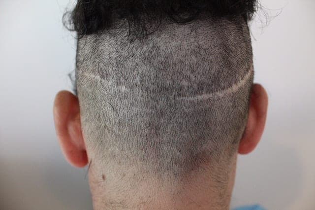 Patient with NW 4-5 level hair loss (Right Side view), FUE Shave test negative, nape and periauricular hair shows a precipitous fall from the mid occipital zone in terms of density, and hair caliber with a discernible line of demarcation. Also shown is his neck showing usable donor hair.Also note how his occipital notch which would have fallen within the traditional safe donor zone is clearly in the retrograde alopecia zone in this FUE shave test illustration